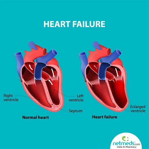 impaired lv systolic function|left ventricular systolic dysfunction symptoms.